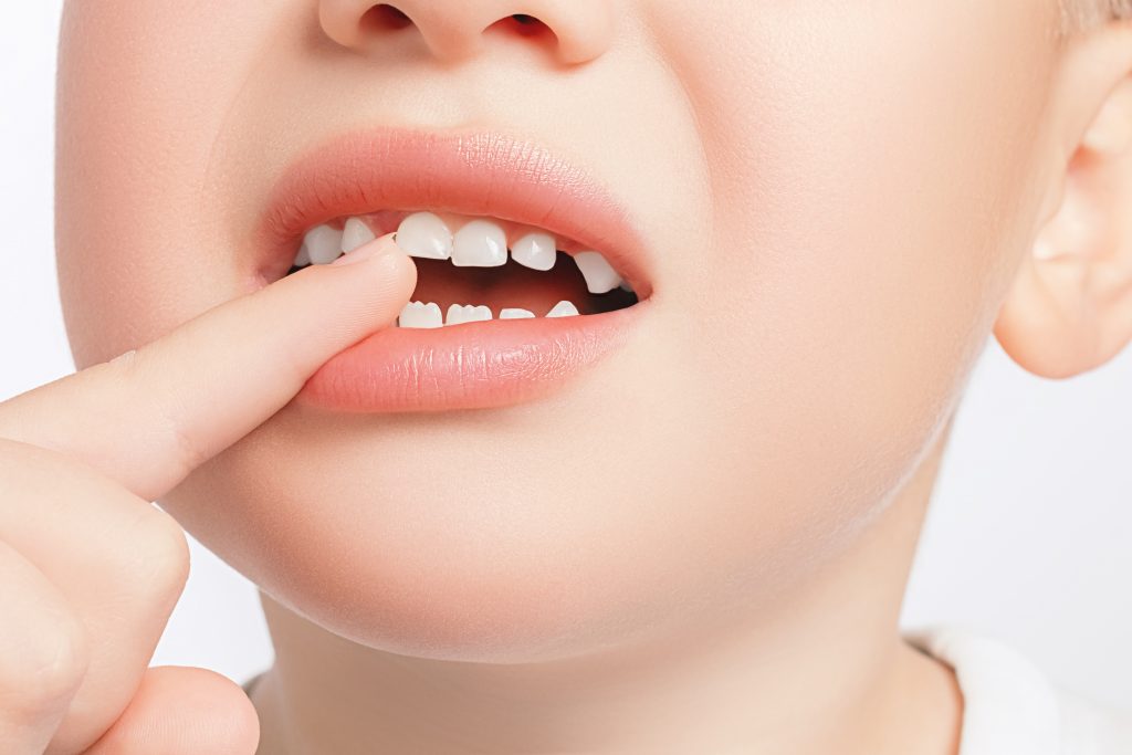 כיצד לשמור על שיני הילדים ומה לעשות בעת חבלה?